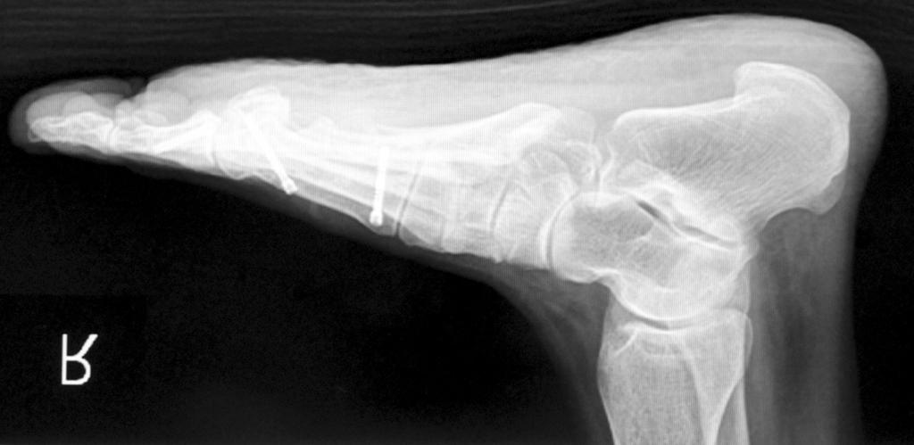180 Vol. 18 No. 4, December 2014 A B Figure 4. (A) This is a preoperative lateral radiograph of a right foot before scarf osteotomy.