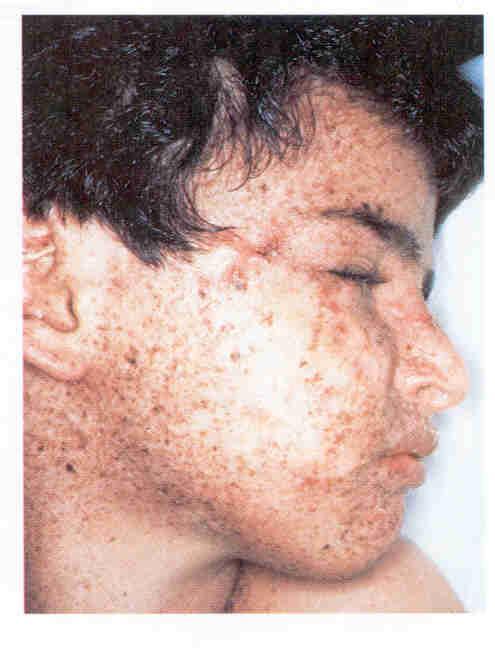 2. Eukaryotic nucleotide excision repair Xeroderma pigmentosum (XP) 은열성형질로보인자인부모는증세가나타나지않지만 XP 아이는햇빛에노출되는부위인팔, 얼굴, 목등에피부암이정상인보다 1000 배정도많이생긴다. 정상인보다피부암이생기는나이도 50 년이이른 8 살정도이다.
