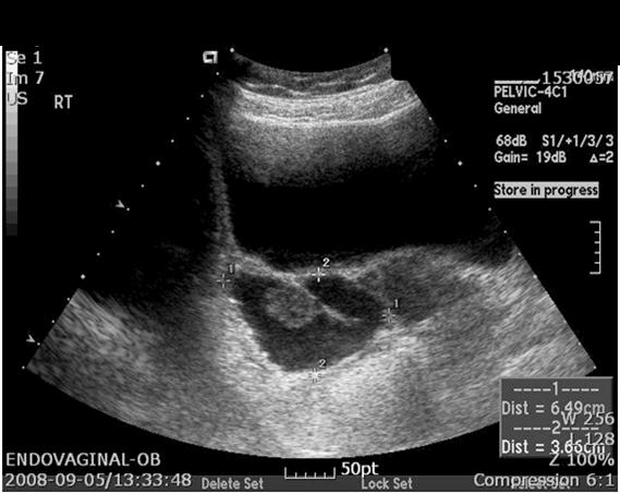 KJOG Vol. 55, No. 11, 2012 Fig. 1. Ultrasonographic finding of the primary fallopian tube cancer. It shows a bilocular cystic mass with intramural nodule, measuring 65 36