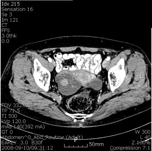 cystic mass, measuring 56 45 45 mm on right and 50 24 50 mm on left. Fig. 2. Pelvic computed tomography finding of the primary tube cancer.