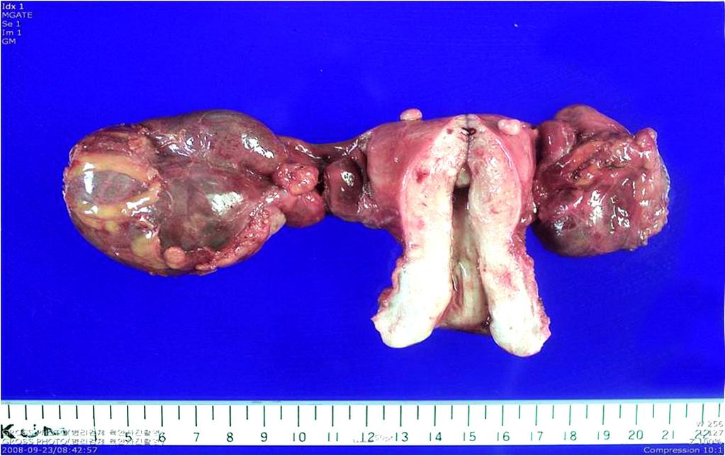 June Kuk Choi, et al. A case of primary fallopian tube carcinoma diagnosed radiologically before operation A B Fig. 4.
