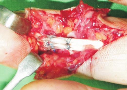 2 flexor tendon cut in the middle finger.