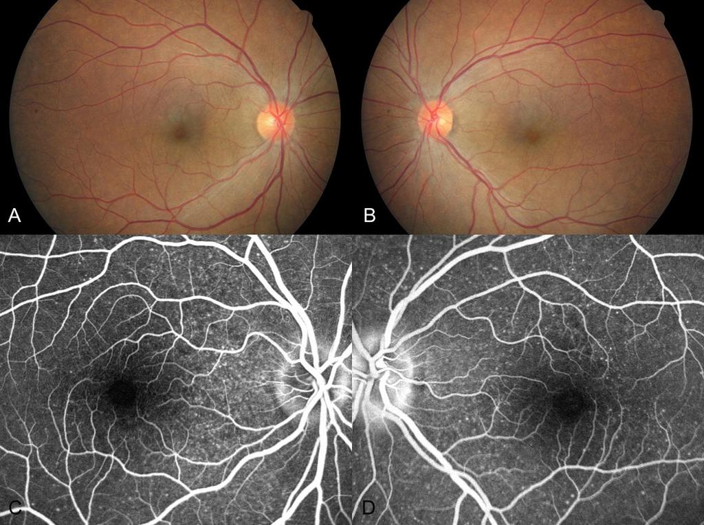 김인태외 : VKH 와감별해야할림프종 Figure 3. Fundus photographs of the right eye (A) and left eye (B).