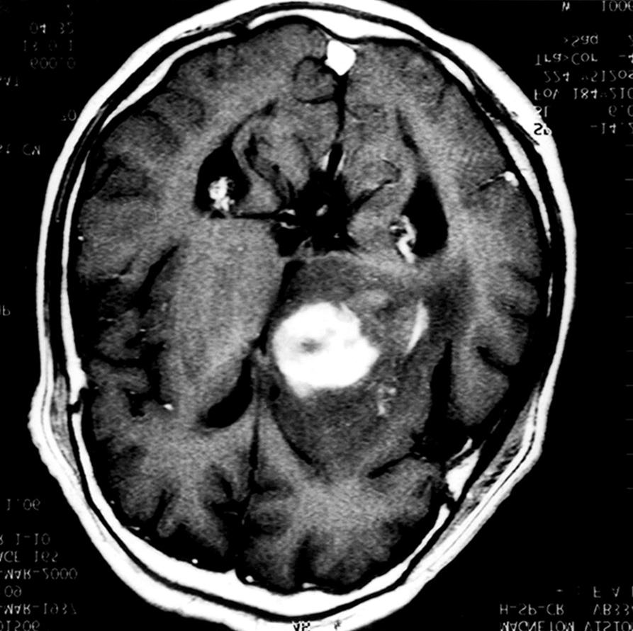 에서 균일하고 강하게 조영증강되는 다발성 종괴 병변이 소뇌반구, 안상, 기저핵과 시상에서 관찰되었다. 기 A B C Fig. 2.