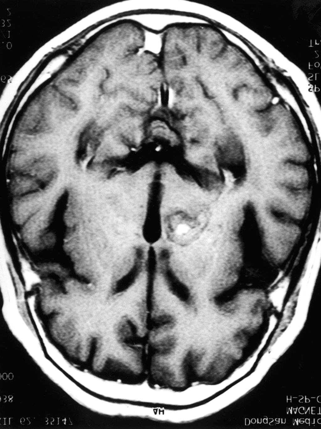 suprasellar, and cerebellum.