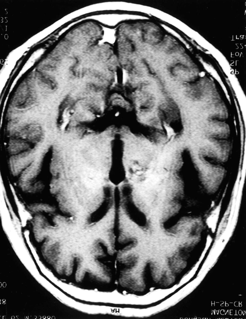 homogenous strong enhancing multiple lesions with minimal mass effect. A B Fig. 3.