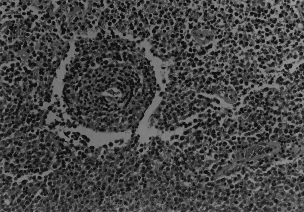 원발성 중추신경계 림프종의 치료전략 A B C Fig. 4. Histopathological analysis of the biopsied tissue showing diffuse proliferation of large lymphoid cells without organoid pattern.