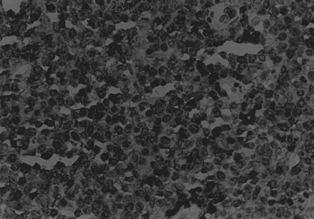 Immunohistochemical stainings show membranous immunoreactive cells with leukocyte common antigen(c) and B-cell(D) immunostain.