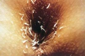 5) 요충 (Trichuris trichiura) 분포및특성 분포지역 : 인구밀도가높은도시 크기및특성 : 수컷 (2 5 mm ) - 의문부호를거꾸로한모양 감염경로 암컷 (8 13 mm x0.