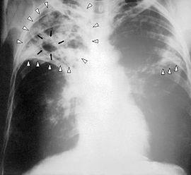 4.5.2 주요인수공통감염병 4.5.2.1. 결핵 ((Tuberculosis) 결핵 X-ray 사진 신체모든부위에침범가능, 특히폐에침범률이높다 병원체 : Mycobacterium tuberculosis, M.