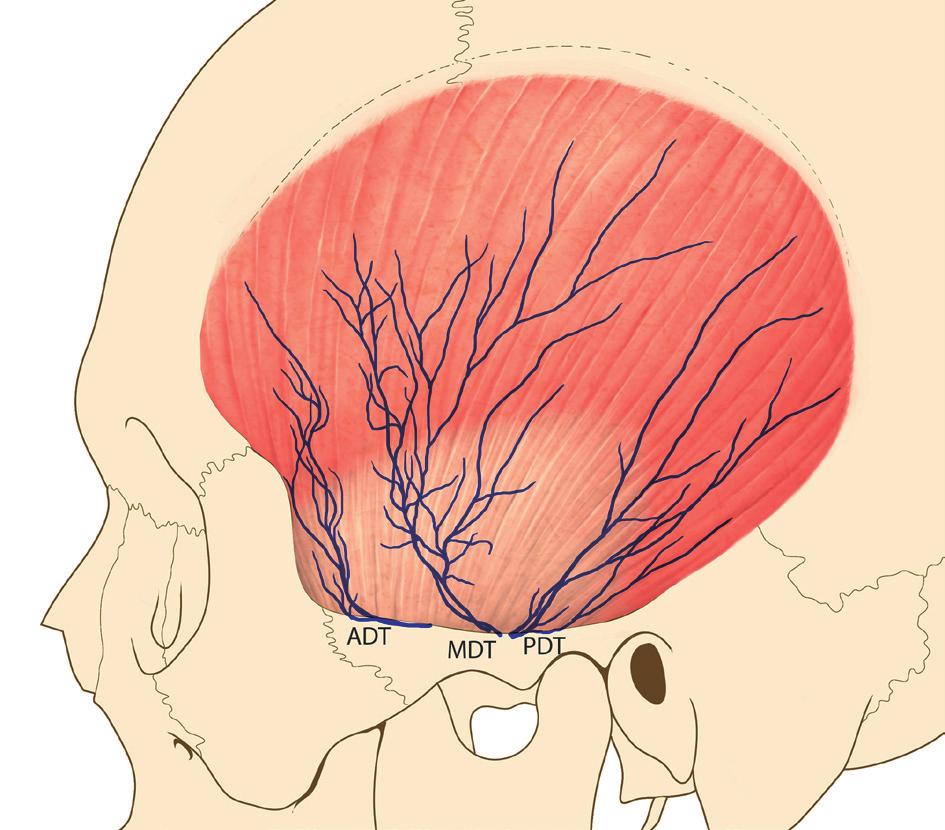 The anatomy of temporal muscle in botulinum toxin injection 후방 1/3은근육이거의수평방향으로주행하며근육사이의힘줄이가운데 1/3보다는상대적으로적다. 근육의양은앞쪽 1/3이가장두꺼우며, 상대적으로후방부와상방부로갈수록얇아지는편이다.