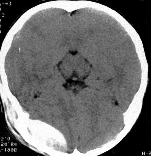 Age and sex distribution Age(yrs) Table 3. Associated intracranial lesions Male Female Total(%) Lesions < 4 5(22.