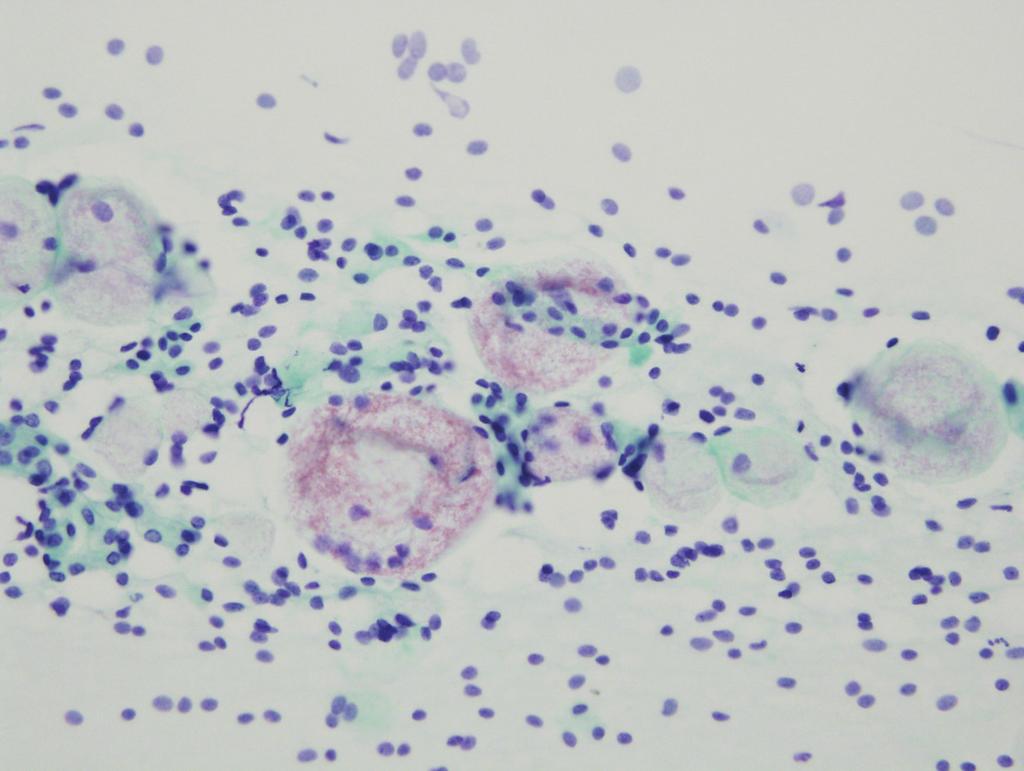 Tubules of ductal cells with a background of clear cells (Papanicolaou stain). Fig. 2. Fine needle aspiration cytology of case 1.
