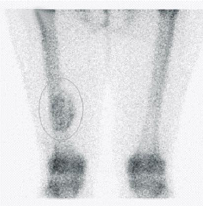 lower part of the left femur (circle) is seen
