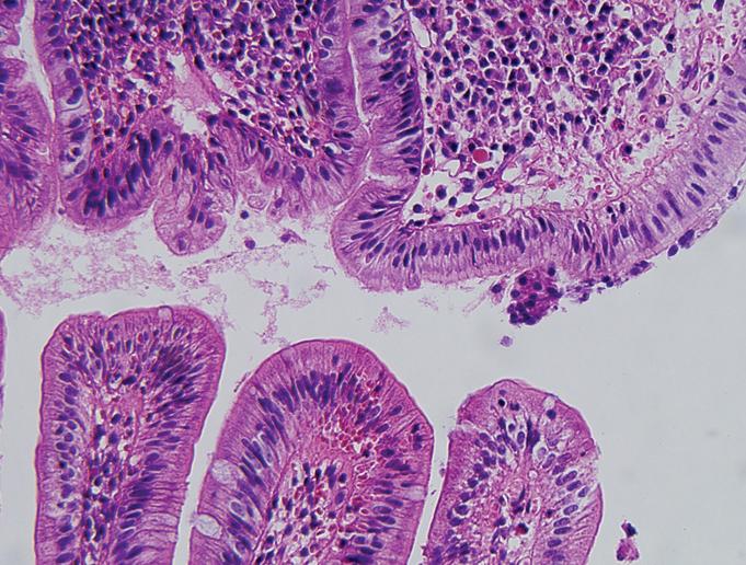 십이지장 위화생의 발생에 영향을 미치는 십이지장의 임상병리학적 소견 장태정 Figure 1. Histologic findings. (A) It shows gastric metaplasia in duodenum (H&E stain, 400).