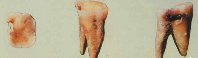평양덕천 승리산동굴 ( 평안남도 ) 1972~3 년북한사회과학원고고학연구소에서발굴. 한반도내에서처음으로구석기시대의인골화석이발견.