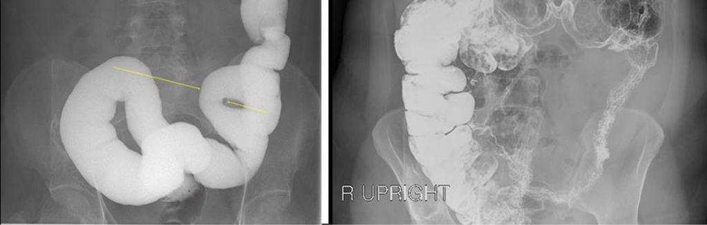 임상적으로매우드물기는하지만구불결장의신경절세포감소증 (hypoganglionosis) 으로인한난치성변비가의심되어바륨조영술과 24시간지연촬영검사를시행하였다. 구불결장에 5 cm 길이의분절성협소부위가관찰되었으며 24시간지연촬영검사에서는구불결장전반에걸쳐조영제가잘통과되지못하였다 (Fig. 3). 24시간지연촬영검사에서신경절세포감소증의범위를좀더정확하게평가할수있었다.