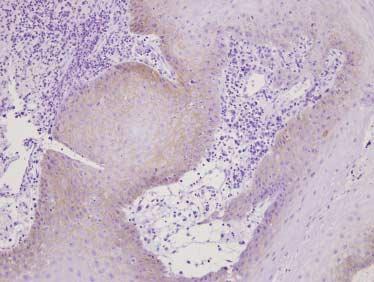 Frozen section of nasal mucosa shows marked inflammation and