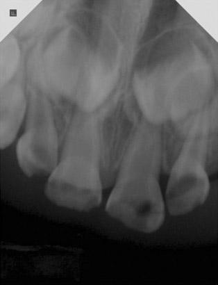 Fig. 5. A: After dental treatments, B: 3 months follow-up. Fig. 4. Periapical radiograph of upper anterior teeth. Fig. 6.