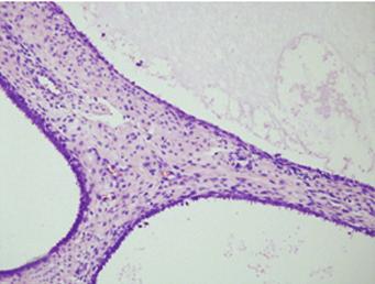 이러한소견은자궁내막용종, senile type에합당한소견이었다 (Fig. 4). 주변의자궁내막조직은낭성위축성 (cystic atrophy) 변화를보였다.