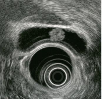 내시경초음파 (endoscopic ultrasonography, EUS) Figure 1. 복부초음파 ; 담낭의콜레스테롤용종. 내시경초음파는내시경선단에초음파탐촉자가붙어있으므로위나십이지장을통해서담낭을자세하게볼수있다 (Fig. 3).