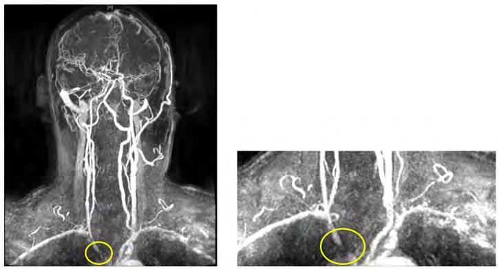 Korean J Clin Lab Sci. Vol. 49, No. 3, September 2017 317 중재적시술이증상개선을위한치료로많이이용되고있다 [2]. 좌측또는우측 SSS 환자는목동맥 (carotid artery, 이하 CA) 이중초음파검사 (duplex sonography) 에서 VA 의혈류가역류하는것을관찰할수있다.