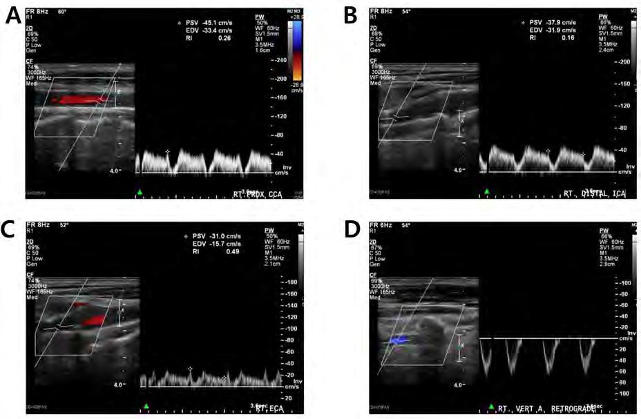 318 Minho Han, et al. Right Subclavian Double Steal Syndrome Table 1. TCD findings in a patient with right subclavian double steal syndrome MFV (cm/s) Right side (Rt) Rt. MCA pro 77 0.63 Rt.