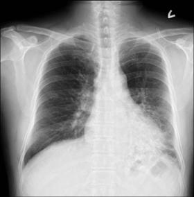 -Byoung Cheol Cheon, et al : Enlarged coronary-bronchial artery anastomosis - 낭성기관지확장증환자에서관상동맥조영술상비정상적인관상동맥-기관지동맥문합을갖는환자 1예를경험하였기에문헌고찰과함께보고하는바이다.