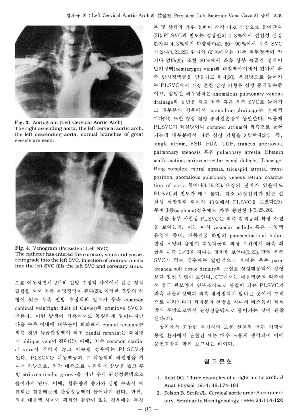 검재규외 : Left Cervical Aortic Arch 와拉發된 Persistent Left Superior Vena Cava 의층례보고 부및상체의좌우절반이각각따로심장으로들어간다 (21). PLSVC 의빈도는정상인의 0.3 % 에서선천성심장환자의 4.3% 까지다양하고 (4), 80-90 % 에서우측 SVC 가있다 (4, 20, 22).