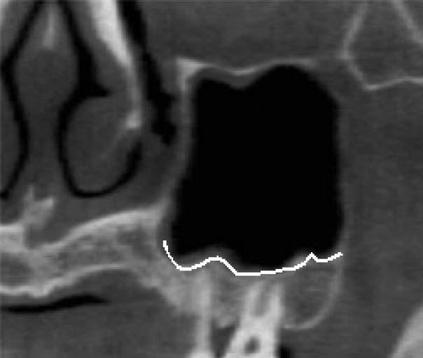 2 Maximum anteroposterior diameter and vertical height of maxillary sinus. Fig.