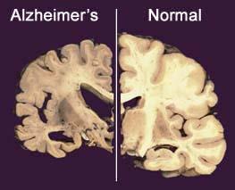 인지장애 알쯔하이머와파킨슨병 (Alzheimer s and Parkinson s Disease)