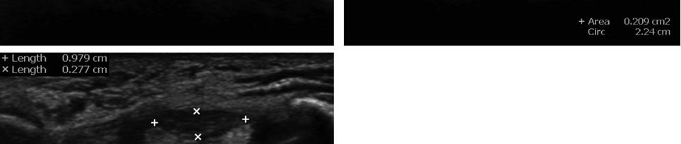 Carpal tunnel syndrome severity grade according to nerve conduction study results Figure 1. Ultrasonographic findings of a normal carpal tunnel and a carpal tunnel with carpal tunnel syndrome.