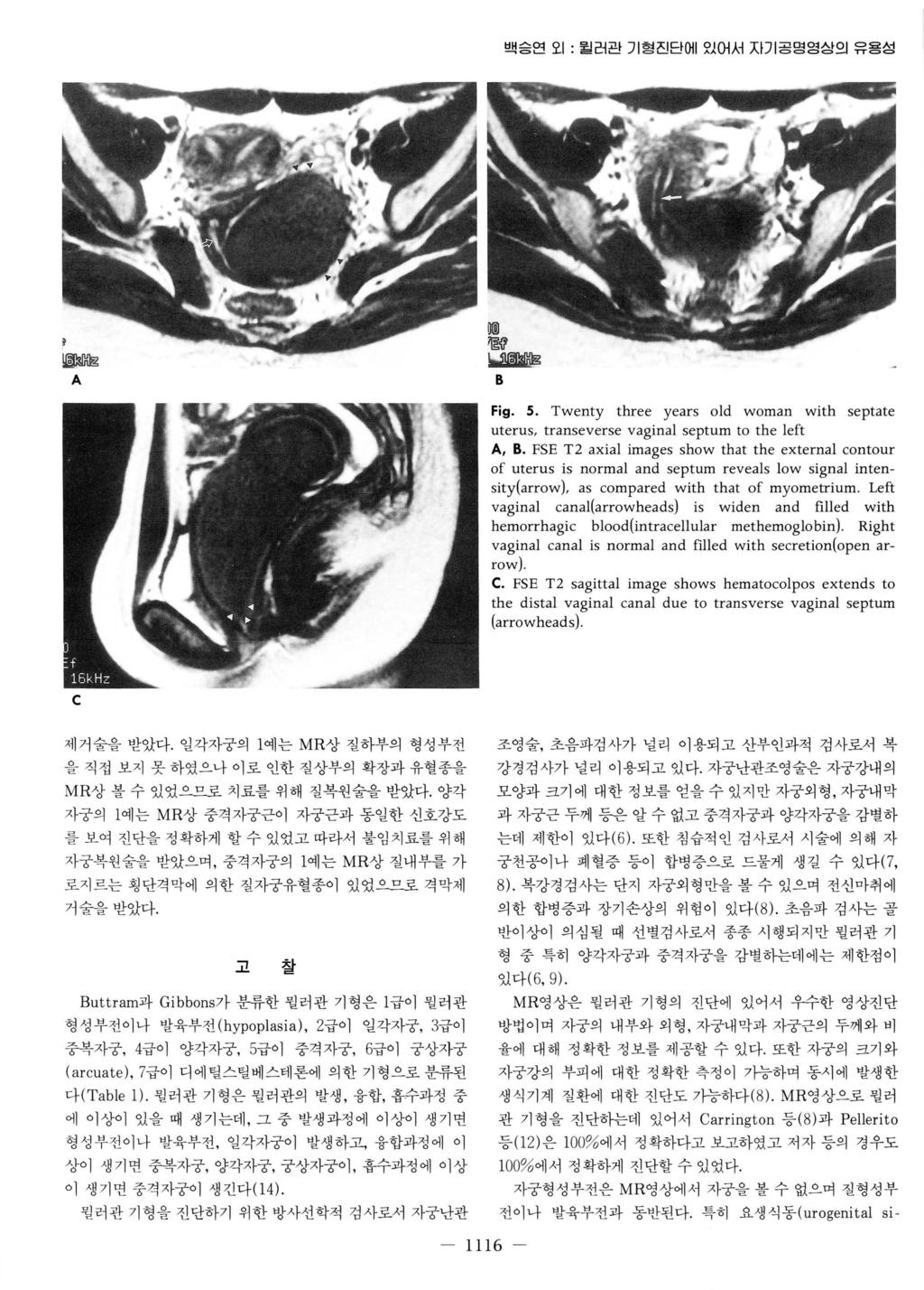 백승연오 1: 윌러관기형진단에있어서자기공명영상의유용성 뀔밟합 A 뼈 훌엠낭뀔앓립 B Fig. S. Twenty three years old woman with septate uterus, transeverse vaginal septum to the left A, B.