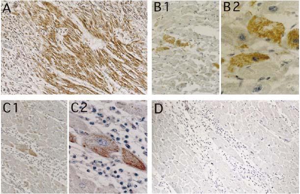 Detection of enteroviral capsid protein VP1 by immunohistochemistry A : fatal myocarditis B : D-CMP C: