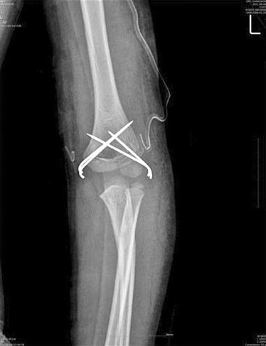 (A) AP view of plain x-ray shows the intercondylar fracture line.