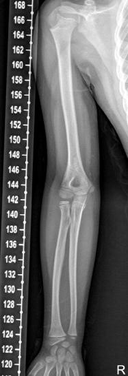(A) Well-bone union is checked in the anteroposterior view of plain x-ray.