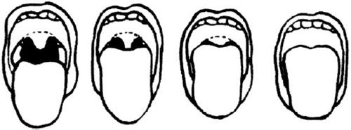 J Surg Crit Care Vol. 2, No. 2, Oct. 2012 Fig. 1. Mallampati classification for grading airways from the least difficult airway (I) to the most difficult airway (IV).