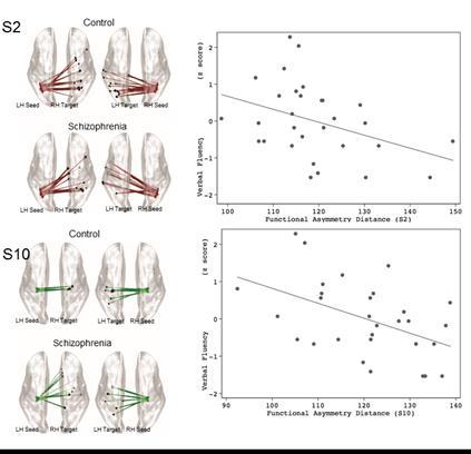 Fig 9. Correlation between subtotal score of semantic verbal fluency (z score) and regions with high asymmetry, the intraparietal sulcus (S2) (r= -0.383, p=0.