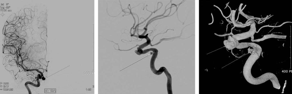 (C) The size of this aneurysm is measured as 4.2 4.4 mm by 3D-CTA. 3D-CTA* : 3 dimensional-computed tomography angiogram A B C Fig. 3. (A) TFCA*(anteroposterior view) shows right internal carotid artery pseudoaneurysm (arrow).