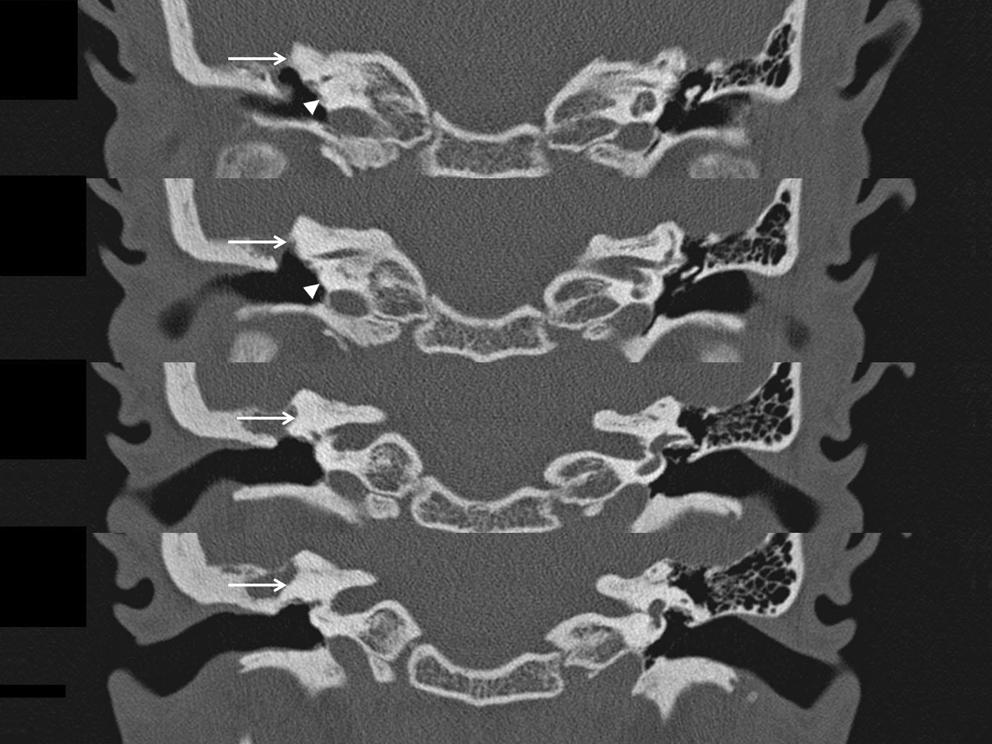 측두골 단층촬영검사에서 우측 유양 동 내에 연부 조직 음영이 있고, 이소골의 형태는 관찰할 증 례 수 없었으며 와우와 전정, 반고리관의 골성미로 형태는 유 지되었으나 내부 림프액 음영은 관찰되지 않았다(Fig. 2).