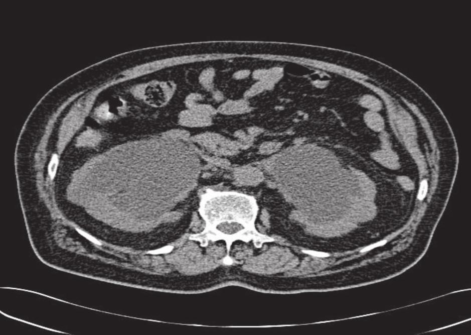 prostate and Foley catheter mal-position at prostatic urethra with urinary