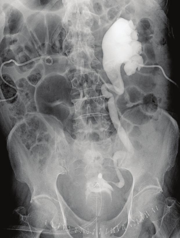 side shows complete obstruction, (C) ntegrade ureteral stent