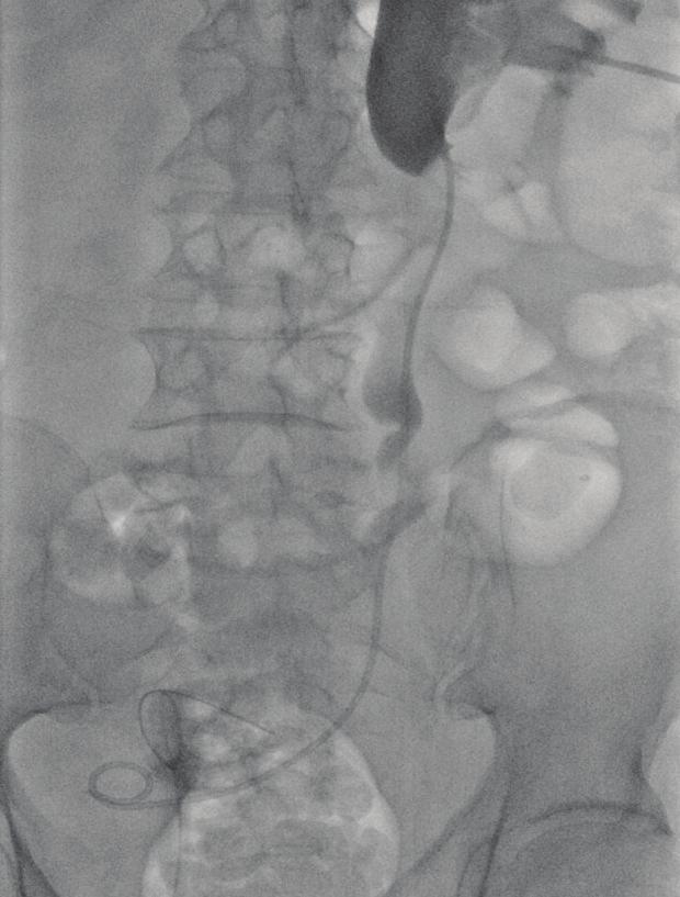 Postoperative cystogram demonstrates contracted bladder volume. Fig.