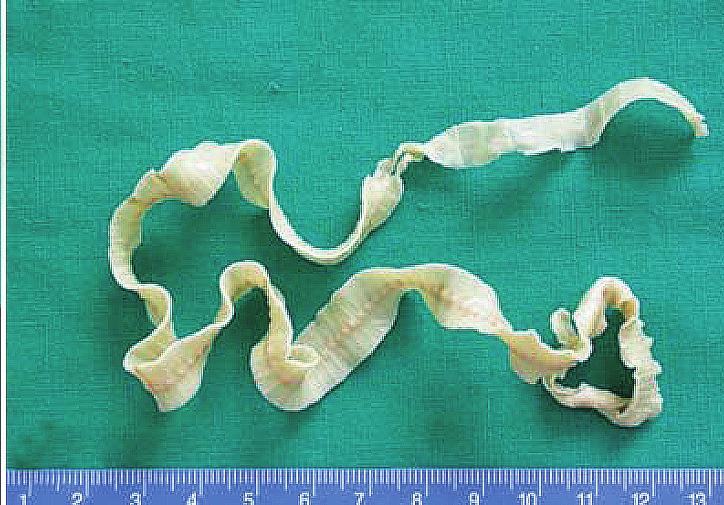 trichiura worms are frequently found by colonoscopic examinations [7].