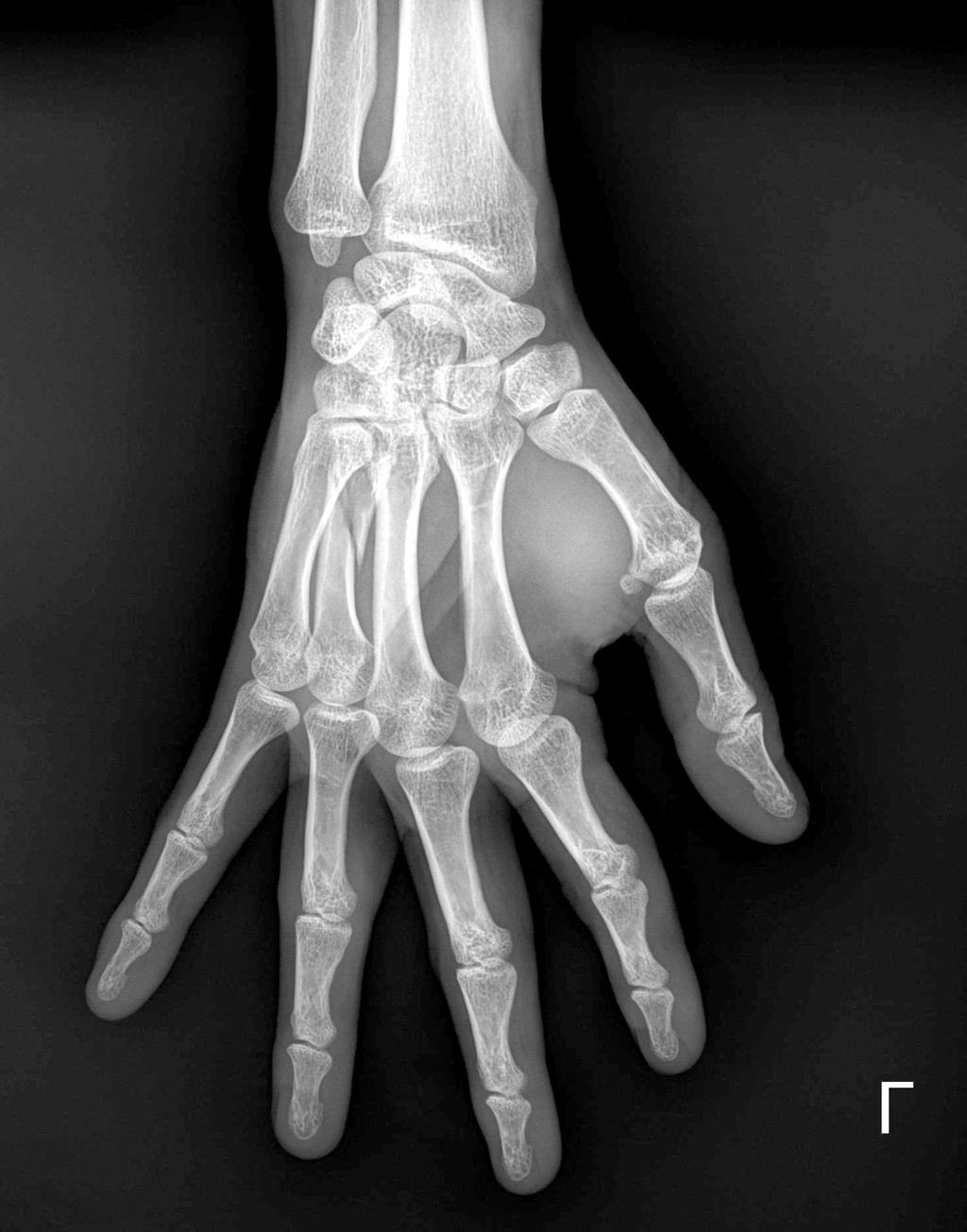 disabilities of the arm, shoulder and hand (DASH) 점수, 그리고 시 방사선적 골유합 시기 및 단순 방사선 측면 사진에서 후방 각