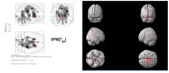 한국산학기술학회논문지제 13 권제 11 호, 2012 [ 그림 1] 뇌에서섭취가증가된부위 (FBP 과 OSEM 비교 ) [Fig.