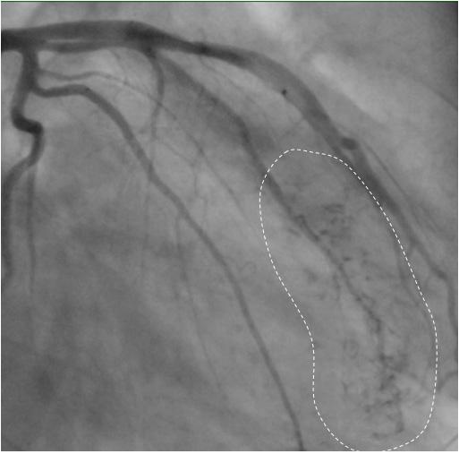 - Jem Ma hn, et al. cquired coronary-cameral fistulae - C D Figure 2. Coronary angiography.
