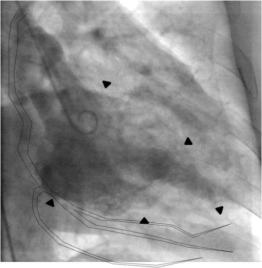 - 대한내과학회지 : 제 84 권제 1 호통권제 629 호 2013 - Figure 3. Left ventriculography. () Left ventriculography, right anterior oblique view.