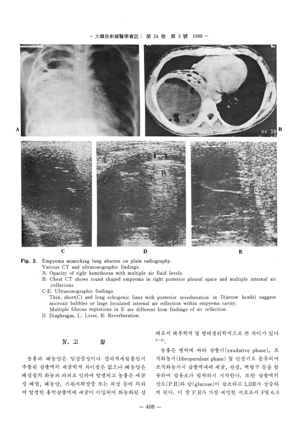 大算放射線훌훌學會誌. 第 24 卷第 3 號 1988 - A R C D E Fig. 2. Empyema mimicking lung abscess on plain radiography. Various CT and ultrasonographic findings.