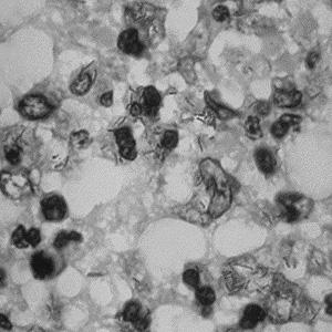 길라잡이 도말검사 : 위양성 (NTM, norcardia, rhodococcus) Carbol-fuchsin stain (Ziehl-Neelsen